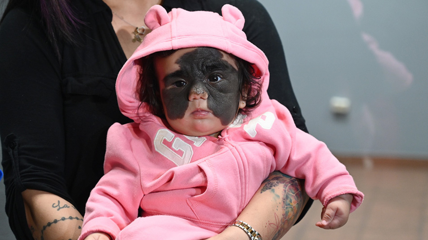U.S. Toddler With Rare Skin Condition Gets First Treatment in Russia