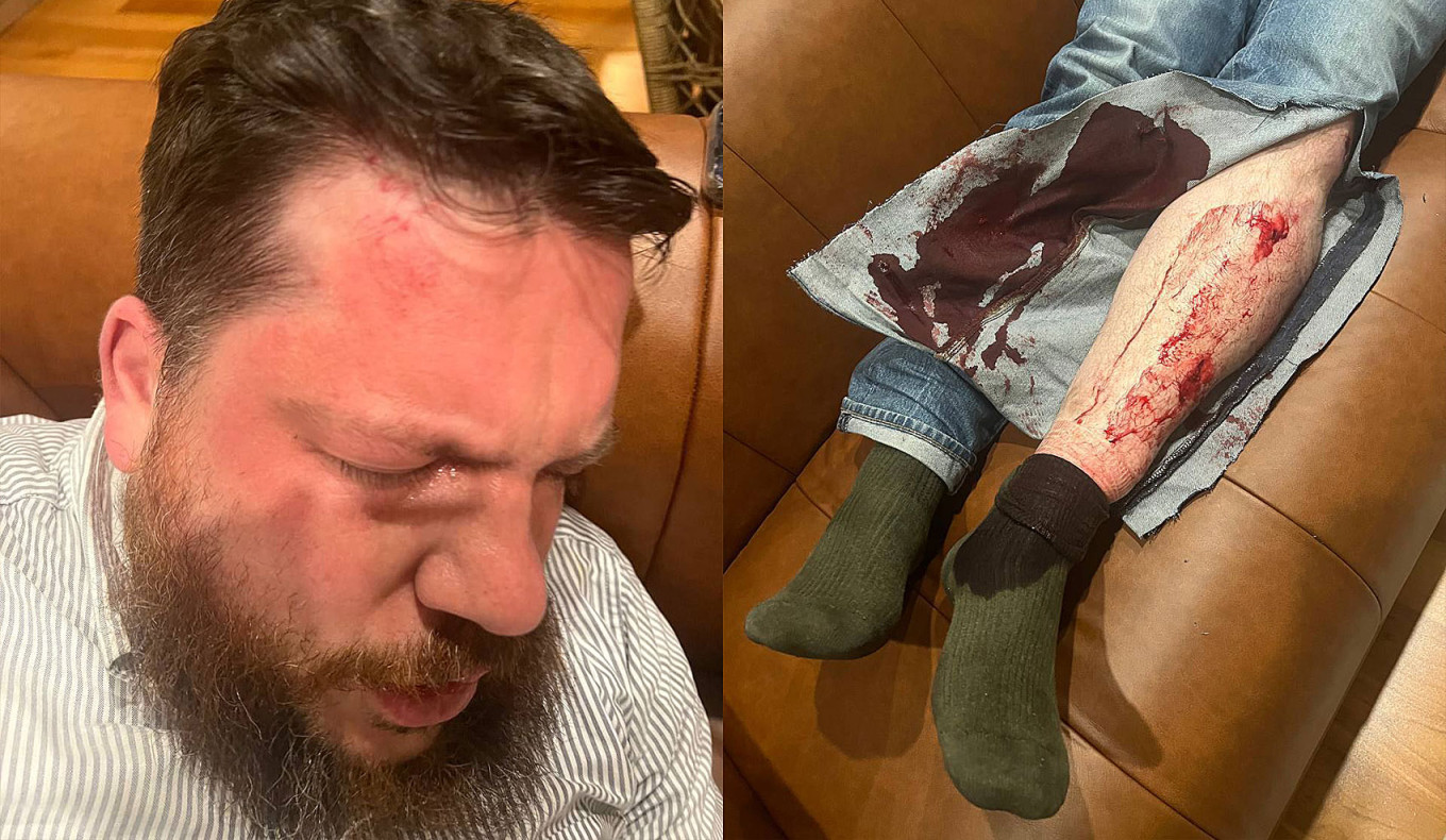  Leonid Volkov's wounds after he was attacked outside his home in Vilnius. Ivan Zhdanov / Telegram 